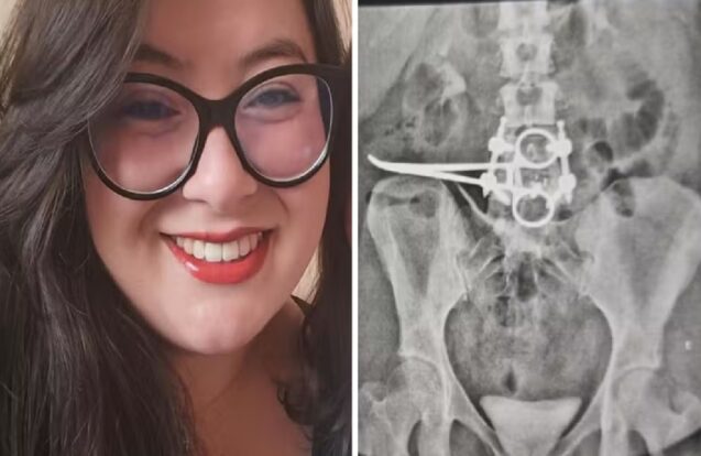 Bragança Paulista, paciente denuncia pinça cirúrgica esquecida no abdômen após cirurgia.