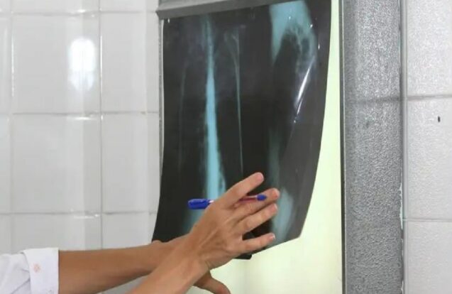 Taubaté reforça busca por casos de tuberculose